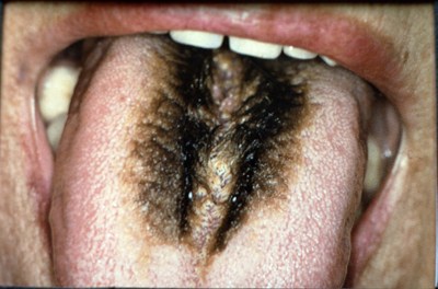 What is hairy tongue what causes it and what is the difference between  black white and yellow hairy tongue  The Irish Sun